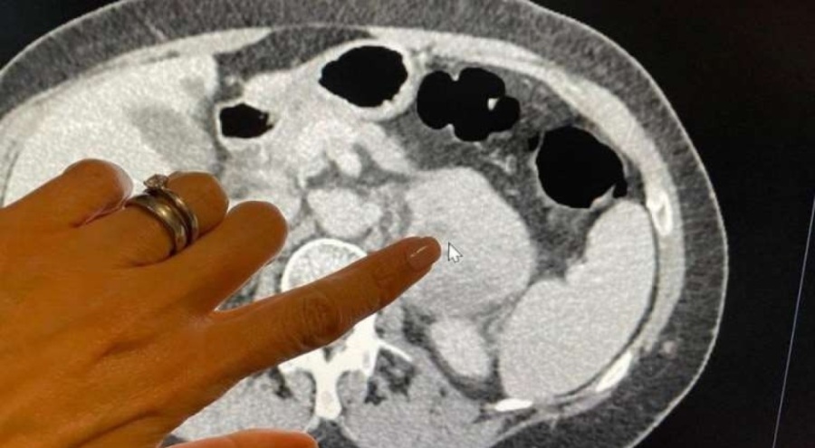 Yapay zeka, kanserin derecesini ve agresifliğini daha isabetli belirleyebilir!