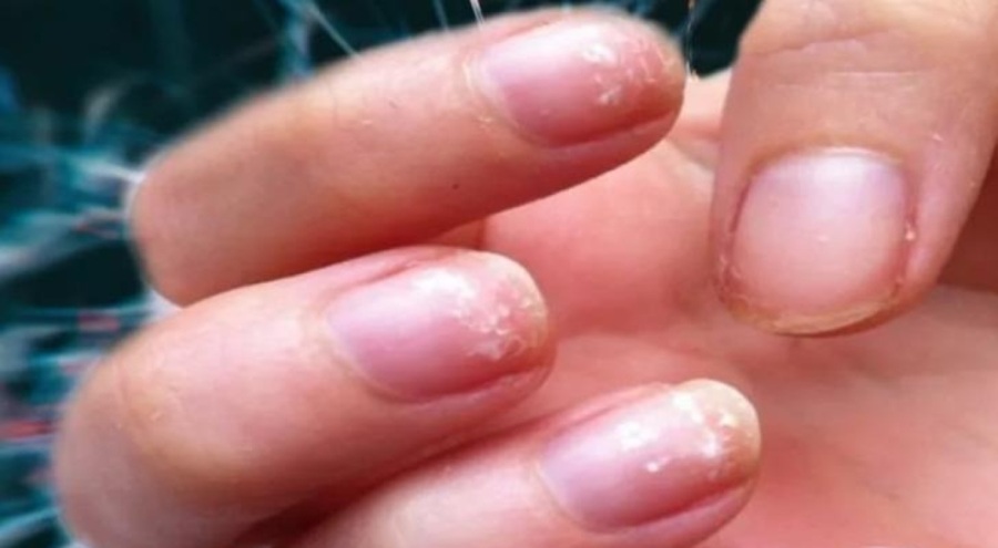 Tırnaklardaki değişime dikkat! Tehlikeli hastalığın belirtisi olabilir