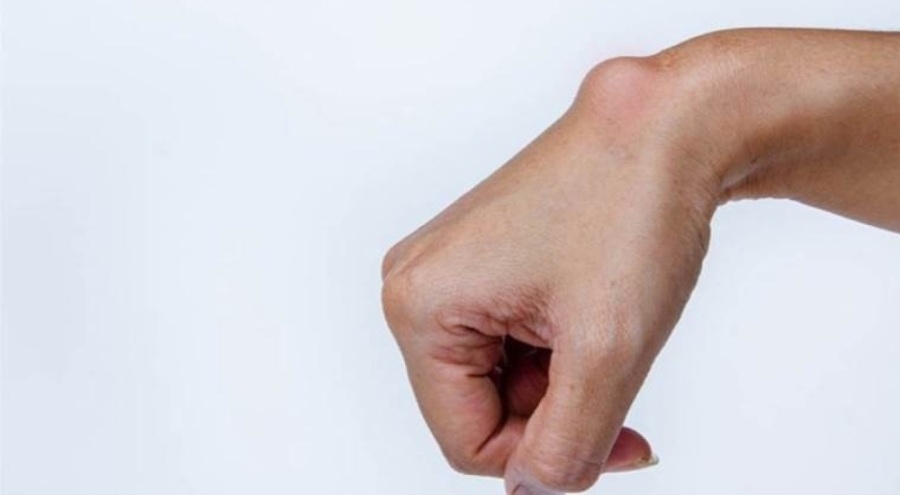 Dermoid kistlerin çok bilinmeyen 3 belirtisi açıklandı