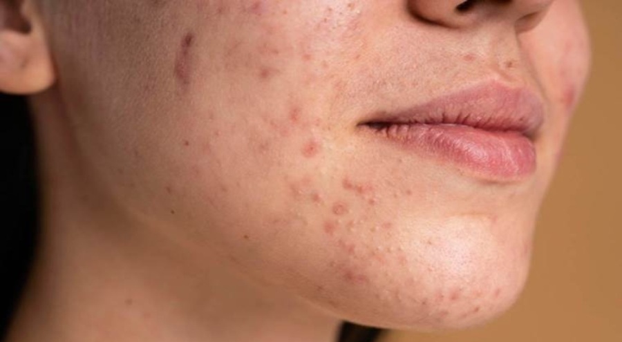 Dermatologlar açıkladı: Sivilcelerinizden nasıl kurtulursunuz?
