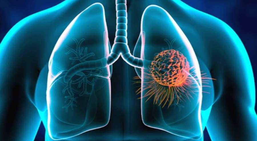 Uzmanı açıkladı: Bu belirtiler akciğer kanserinin habercisi olabilir