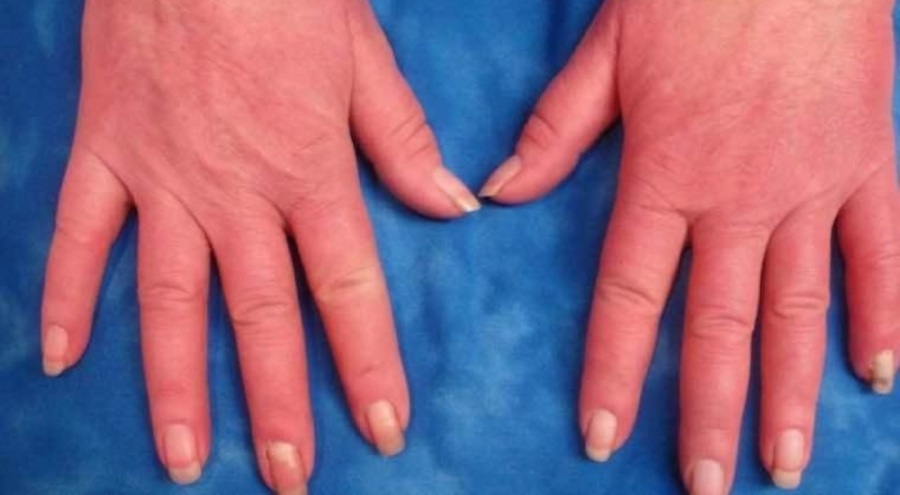 Uzmanı uyardı: Soğuk havalarda Raynaud hastalığına dikkat!
