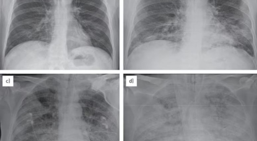 Çin'de çocukları etkileyen "gizemli zatürre salgını" ile ilgili korkutan detay ortaya çıktı