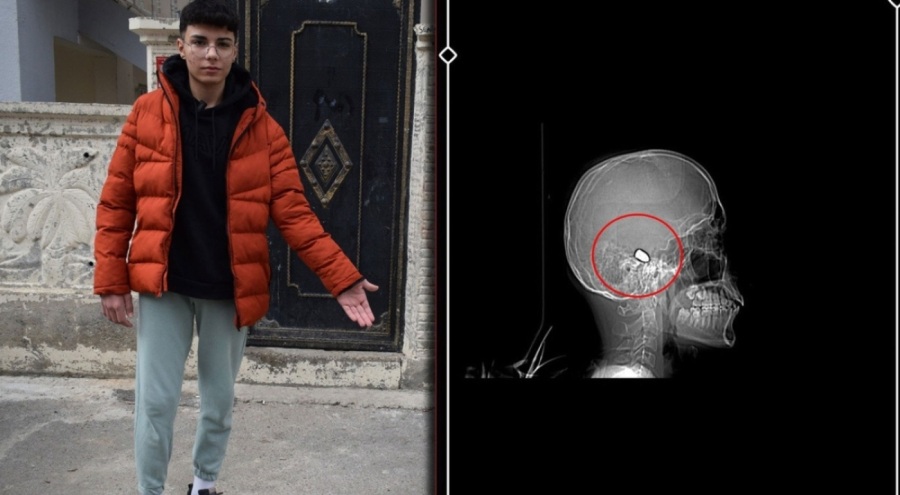 Yusuf, 1,5 aydır başına isabet eden yorgun mermi ile yaşıyor