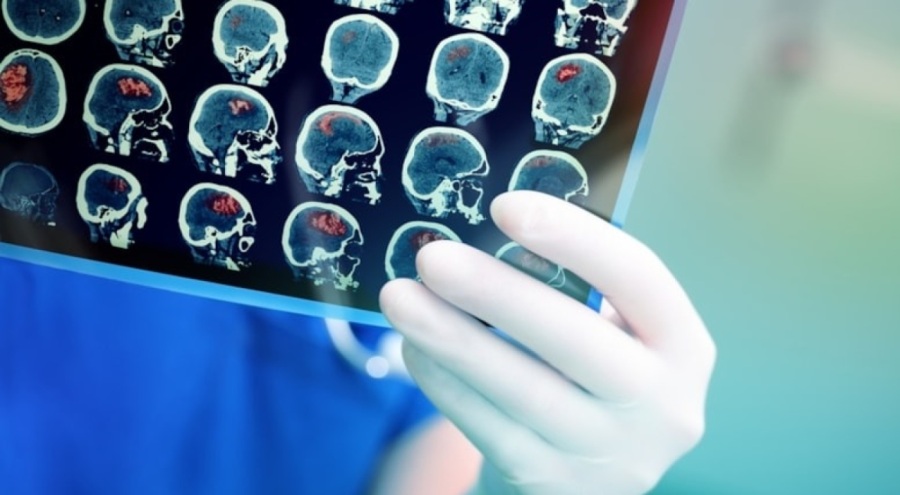 Menopoz dediler, beyin tümörü olduğu ortaya çıktı