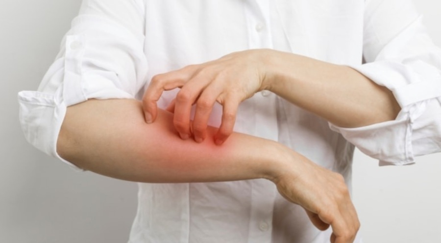 Uyuz vakalarındaki artış doktorları endişelendirdi!