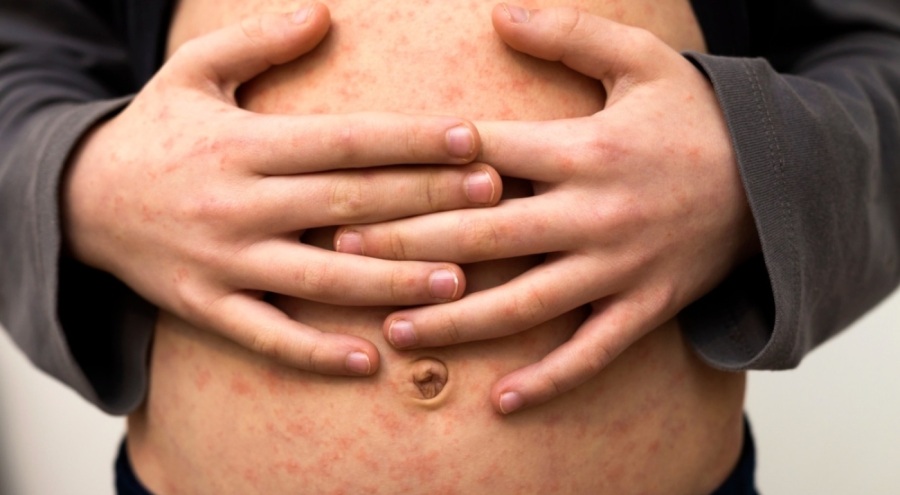 Hamilelikte kızamıkçık nedir?