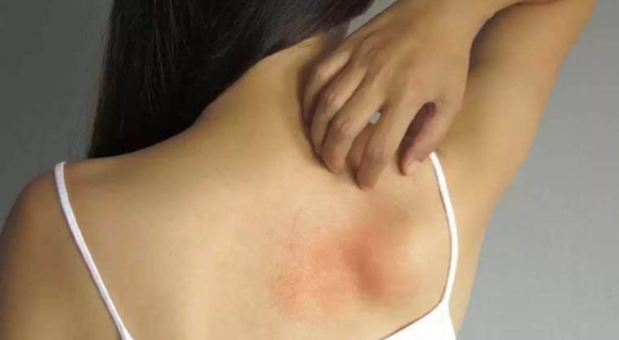 Histamin İntoleransı nedir?