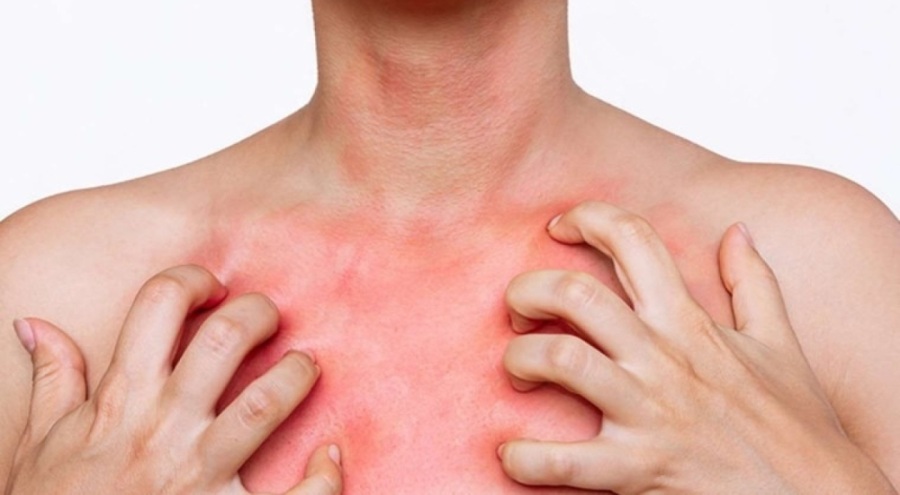 Dermatoloji uzmanları duyurdu: Uyuz hastalığının tedavisi kolaylaştı