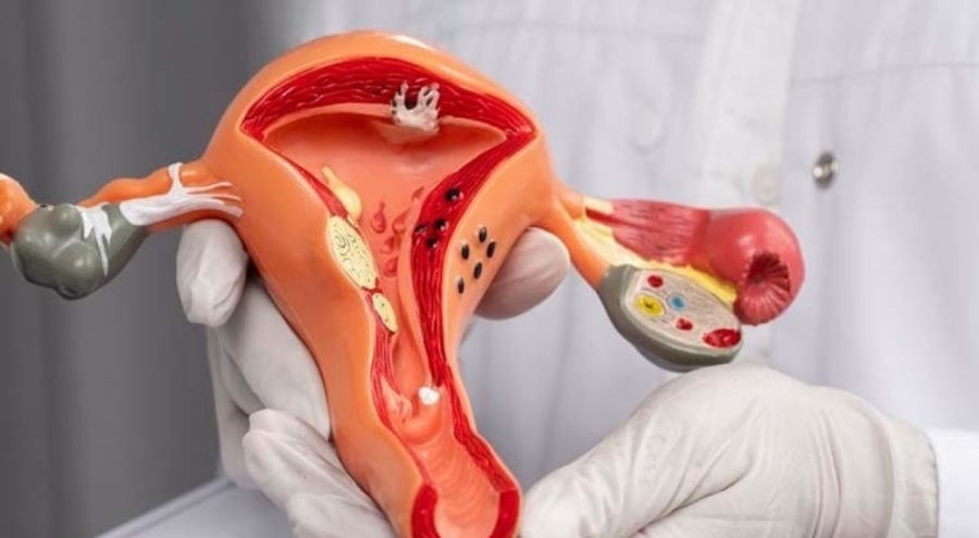 Uzmanından Rahim Ağzı Kanseri uyarısı: Hayati öneme sahip