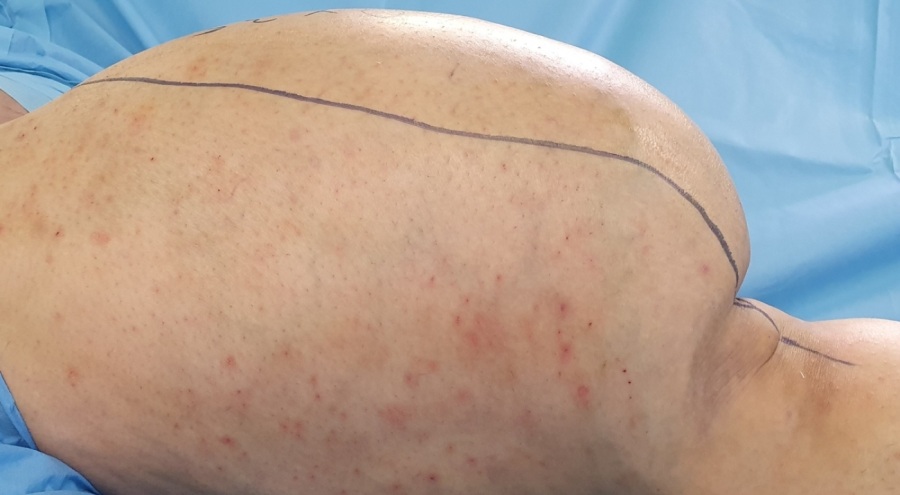 Ameliyatta kesilmekten kurtulan bacağından 6 kilo tümör çıkarıldı