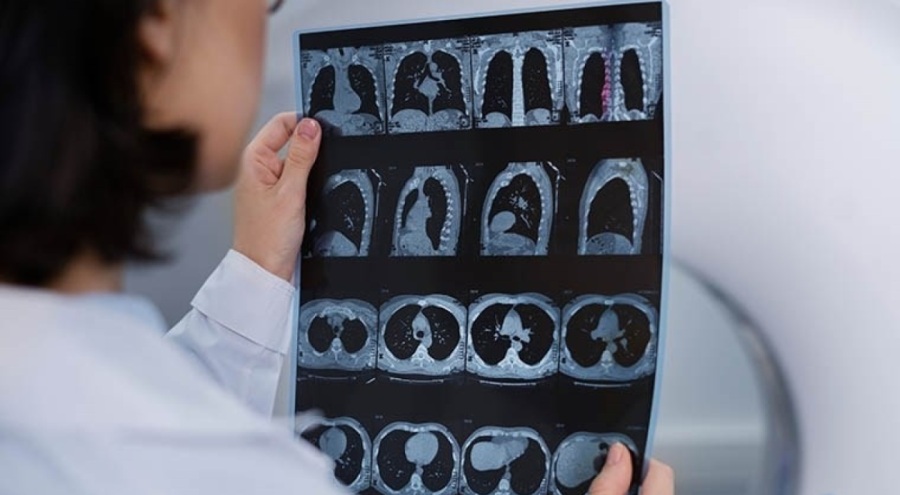 Uzmanı açıkladı: Kan sulandırıcı kullanımı beyin kanaması riskini artırabilir