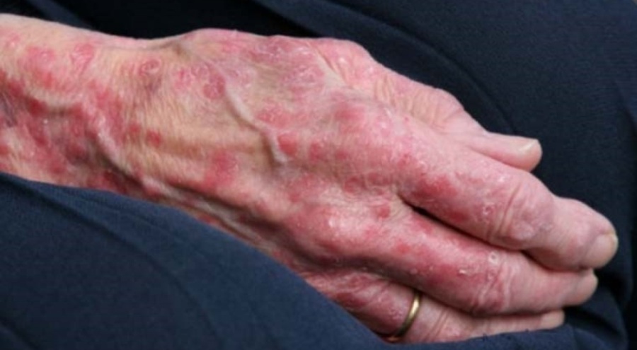 Cüzzam hastalığı uyarısı! Tedavi edilmediği takdirde sakatlığa yol açıyor'