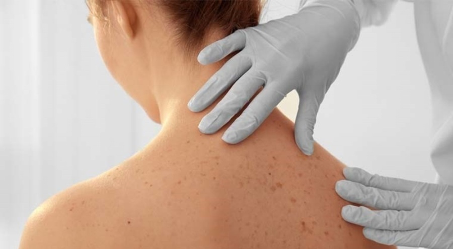 Bu belirtilere dikkat: Dünyada en sık görülen kanser türü...