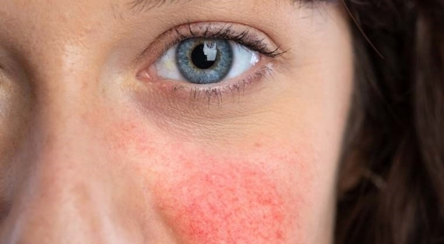 Gül hastalığı (Rozasea) nedir? Belirtileri neler?