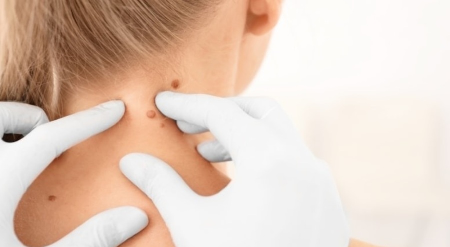 Uzmanı açıkladı: Et beni neden olur, nasıl düşer?