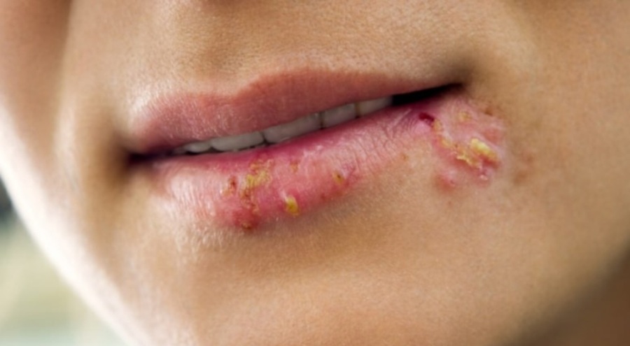 Araştırma ortaya koydu: Bu virüs demans riskini artırıyor