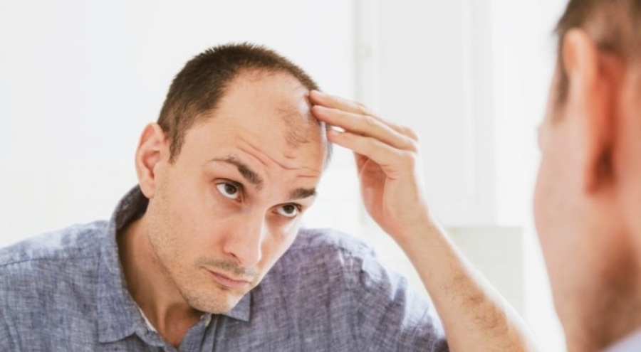 Erkeklerde saç dökülmesinin 3 nedeni