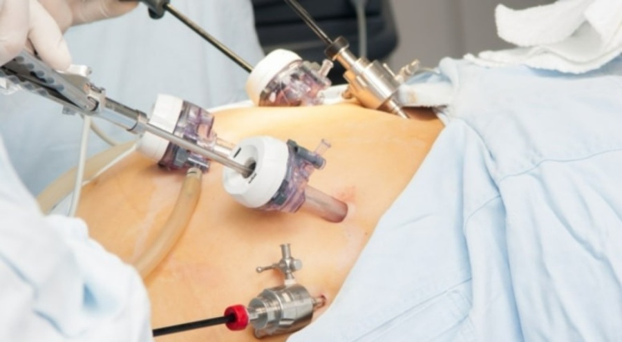 Kilo verme ameliyatlarıyla ilgili dikkat çeken bulgu