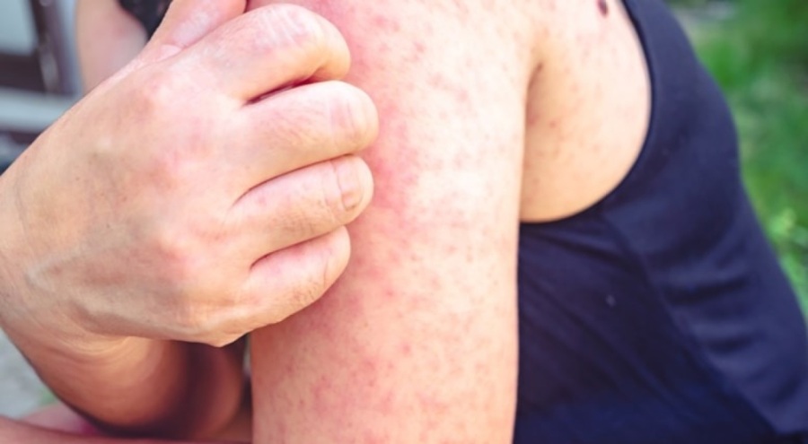 DSÖ'den kızamık uyarısı