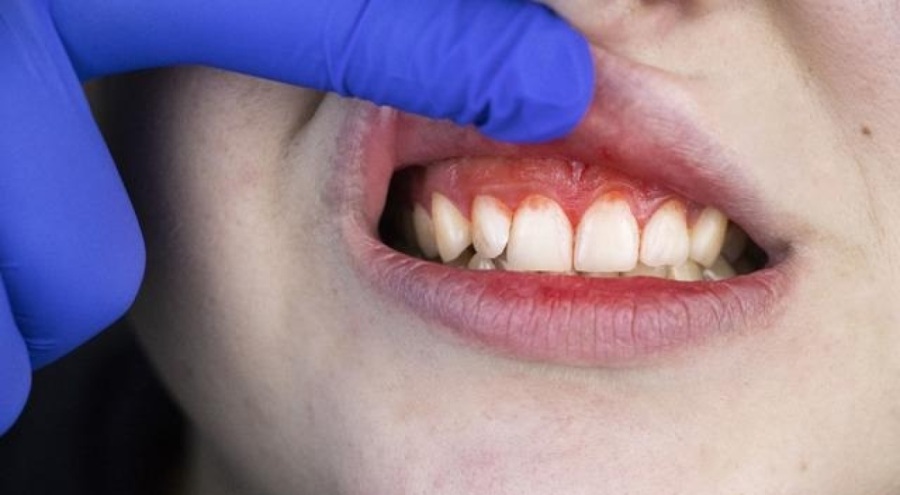 Diş iltihabını ve ağrısını geçiren mucize karışım!