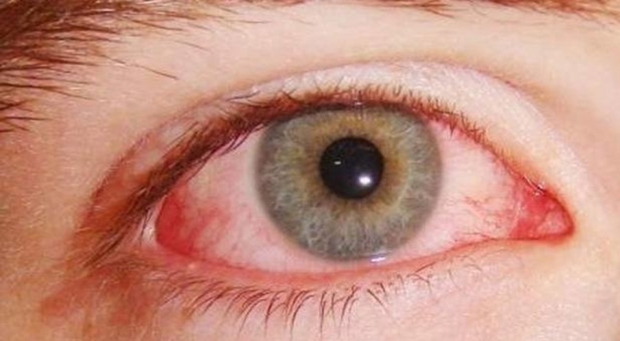 Uzmanı uyardı: Göz kızarıklığı deyip geçmeyin!