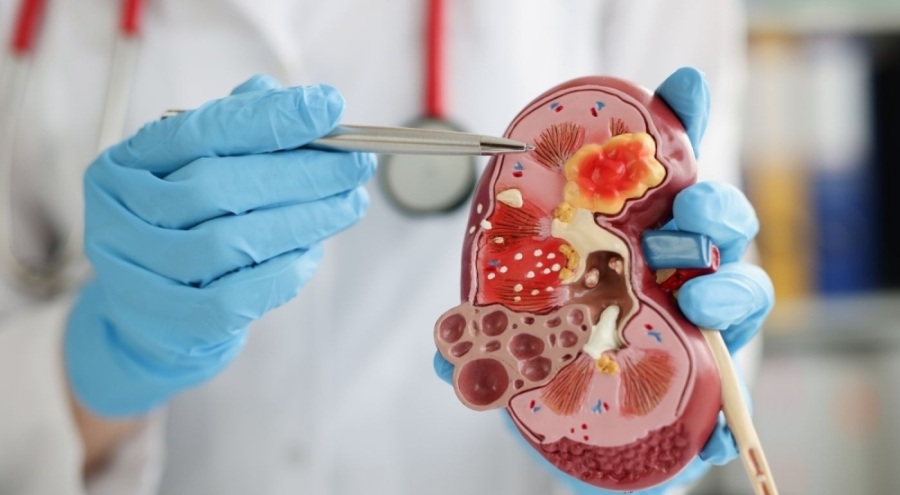 Gizli kanserin en yaygın 3 belirtisi!