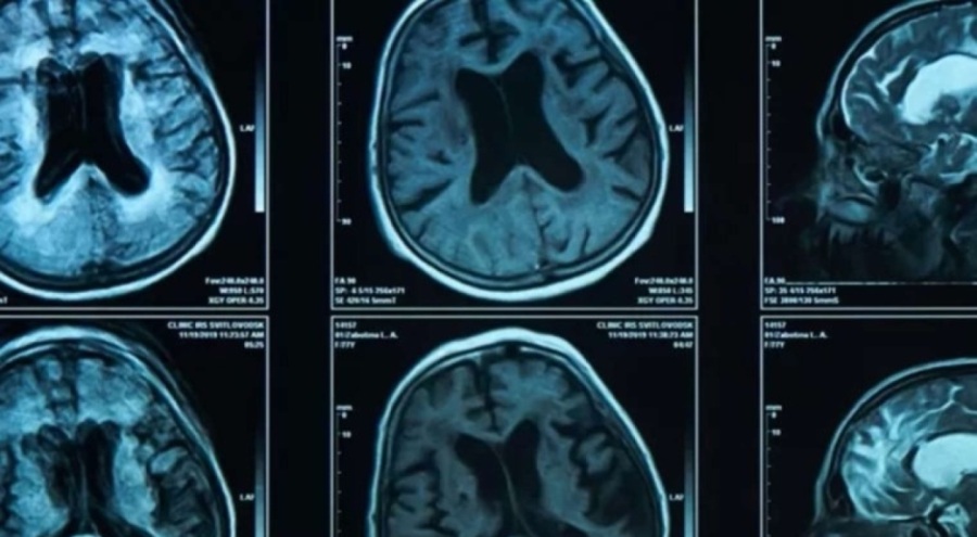 Uzmanı uyardı: Beyin tümörünün belirtileri her hastada farklı