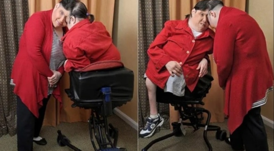 62 yıl birbirlerine başlarından yapışık olarak yaşadılar