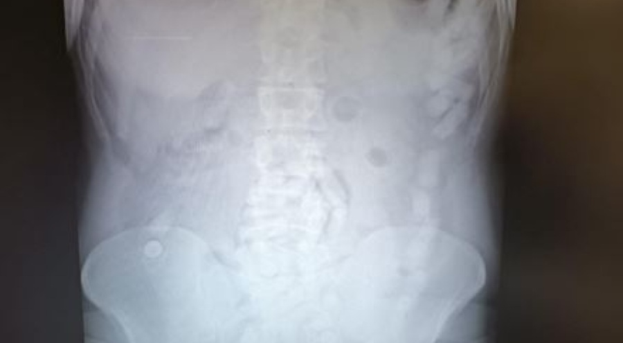 Midesinde uyuşturucu kapsülü ile yakalanan şüpheli tutuklandı