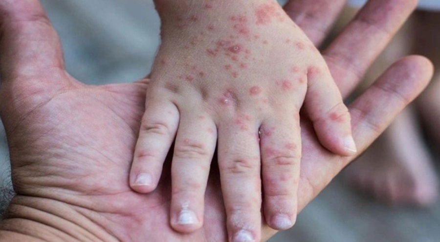 DSÖ ve UNICEF açıkladı: Kızamık vakaları artıyor