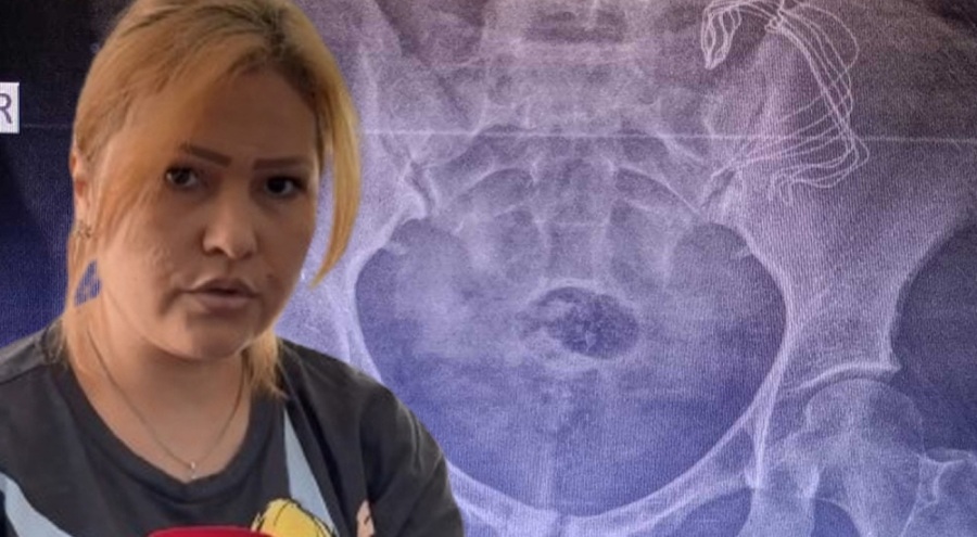 Doğumda akılalmaz skandal! 10 ay sonra karnından çıktı