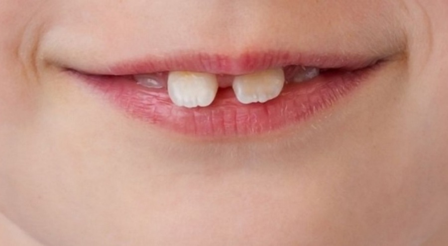 Çocuklarda diş estetiğine dikkat