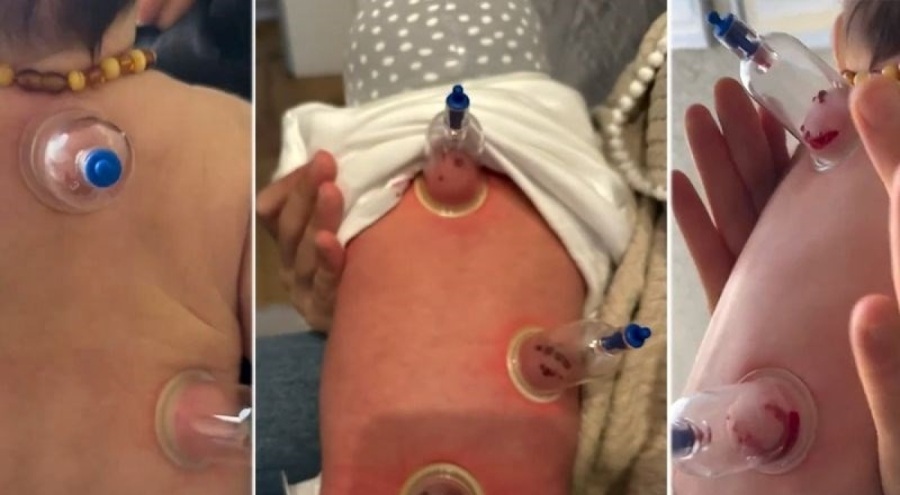 Bebeklere hacamat yapıyorlar