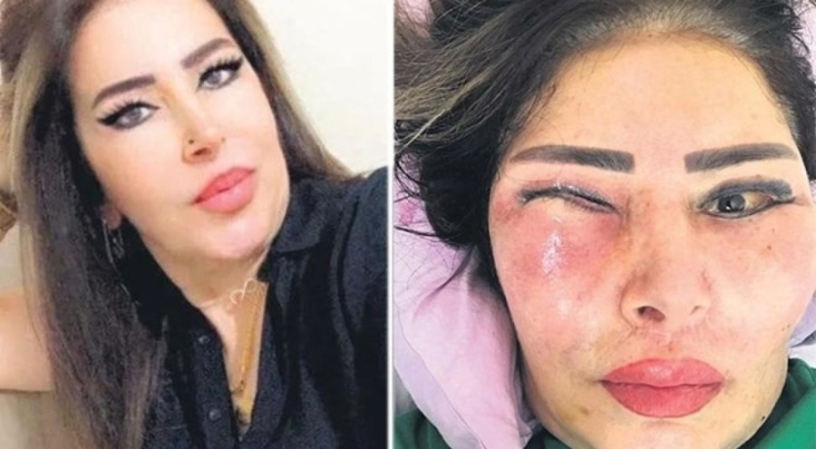 Yüz gerdirme ameliyatı olan kadının hayatı kabusa döndü! Gözünün içinde et çıktı