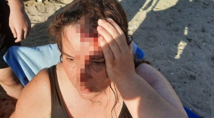 Denizde yüzen kadına jet ski çarptı!
