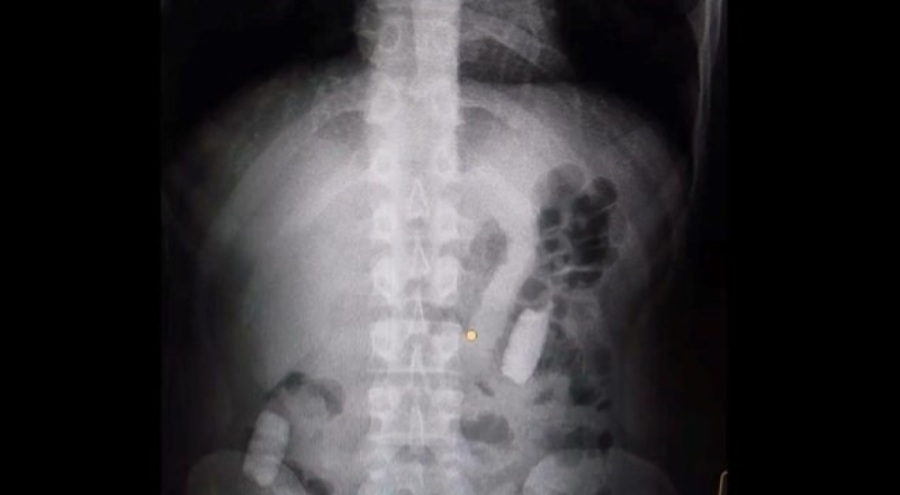 Midesinde taşıdığı 1 kilo uyuşturucuyla yakalandı