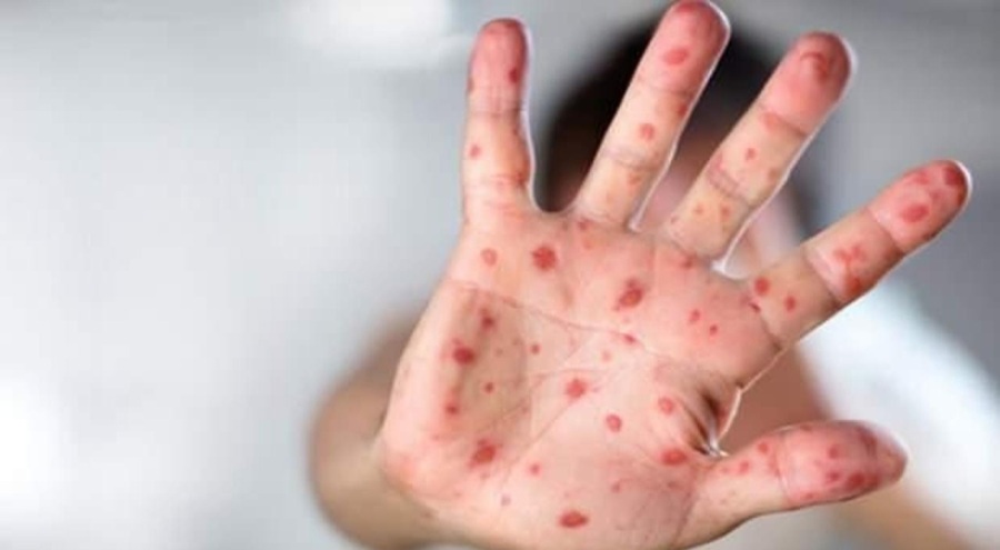 Türkiye'de 'maymun çiçeği' vakası var mı? Açıklama geldi