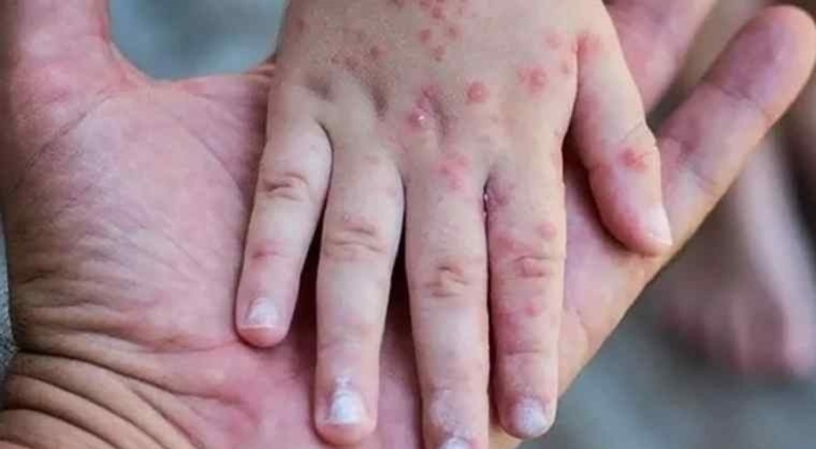 Sağlık Bakanlığı açıkladı: Türkiye'de maymun çiçeği var mı?