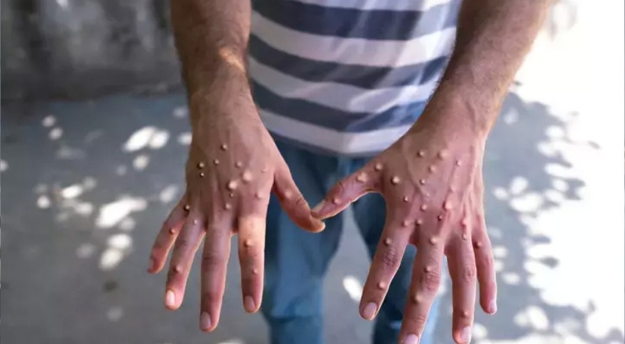 Maymun çiçeği Avrupa'ya sıçradı: İsveç ilk vakayı duyurdu