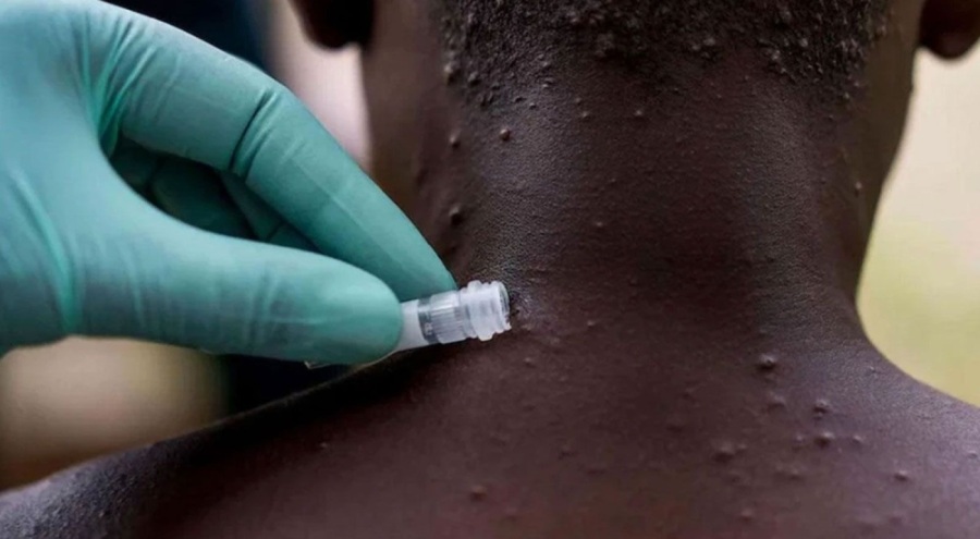 Dünya maymun çiçeği virüsü tehdidi altında! Vaka ve ölü sayısı artıyor