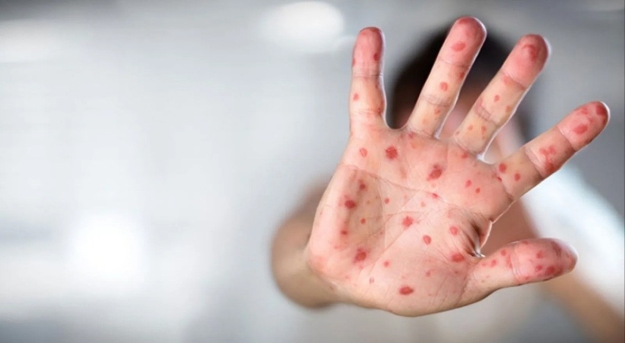 Avrupa'da M çiçeği alarmı: Vakalar artabilir