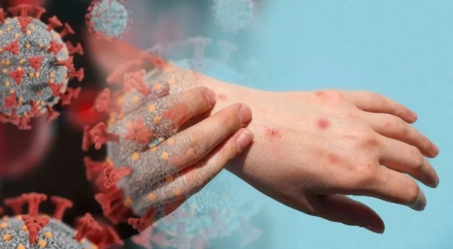 Ankara'da M Çiçeği virüsü şüphesi iddialarına açıklama!