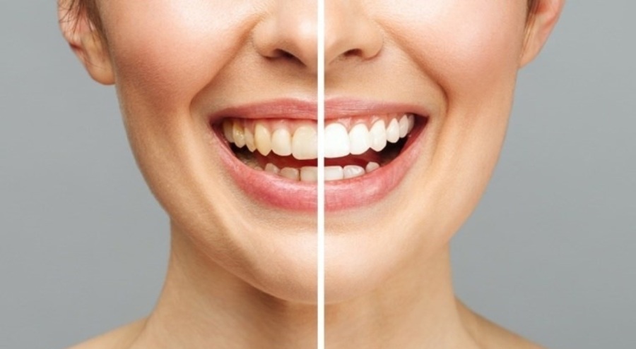 Dişlerde sararmaya neden olan 'en yaygın' hata