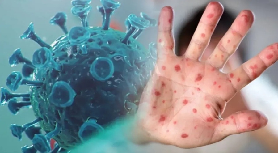 DSÖ'den M Çiçeği Virüsü açıklaması: Salgınlar durdurulabilir!