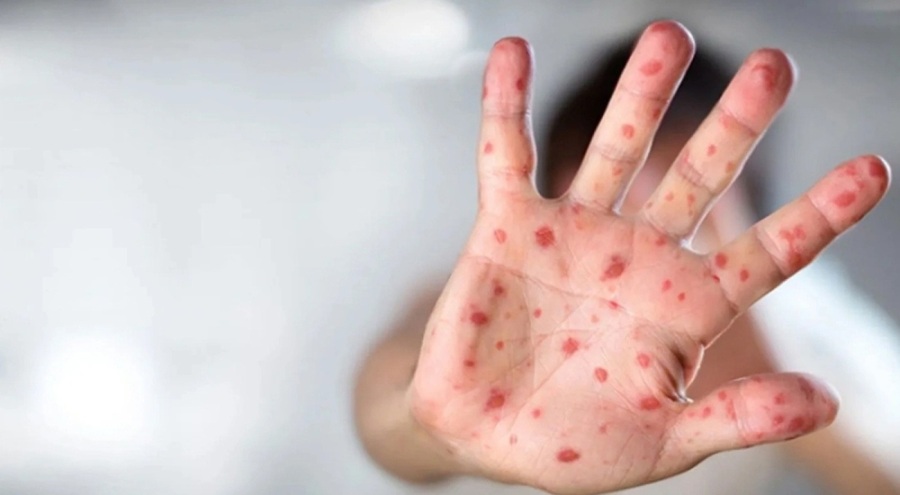 Bir ülkede daha M çiçeği virüsü alarmı verildi