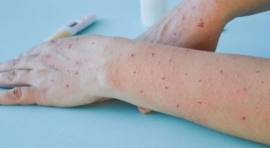 Dünya Sağlık Örgütü, M çiçeği virüsüne karşı aşı onayı