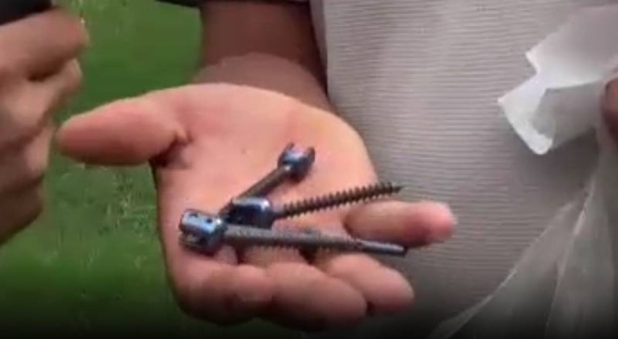 Vücuduna platin takıldığını ikinci ameliyatta öğrendi