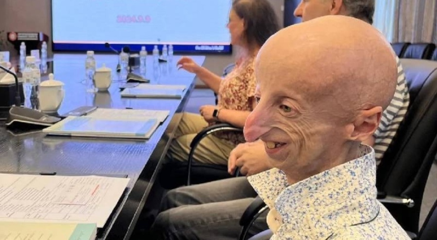 Benjamin Button hastalığının en uzun yaşayan hastası 28 yaşında hayatını kaybetti