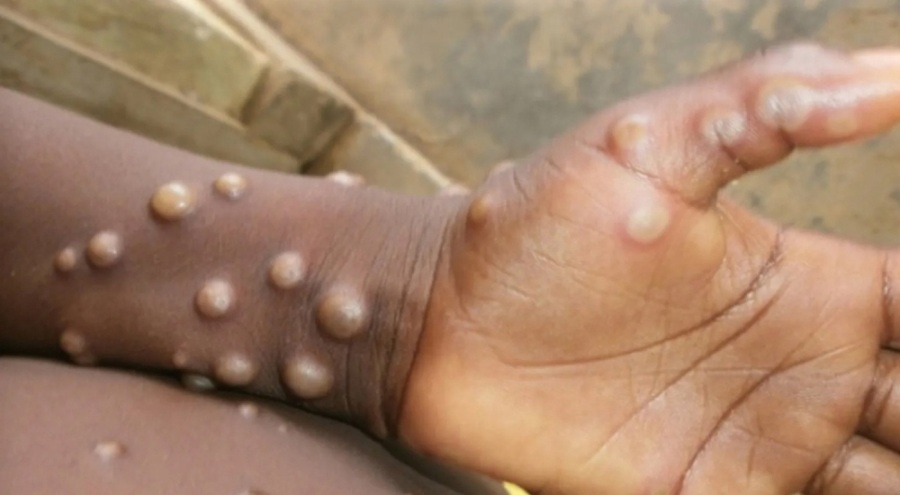 İki Afrika ülkesinde daha M çiçeği virüsü tespit edildi